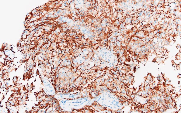 17D2 Demyelination, inflammatory (Case 17) NF 20X 1