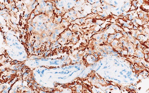 17D3 Demyelination, inflammatory (Case 17) NF 40X 1