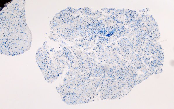 17F Demyelination, inflammatory (Case 17) CD20X 1