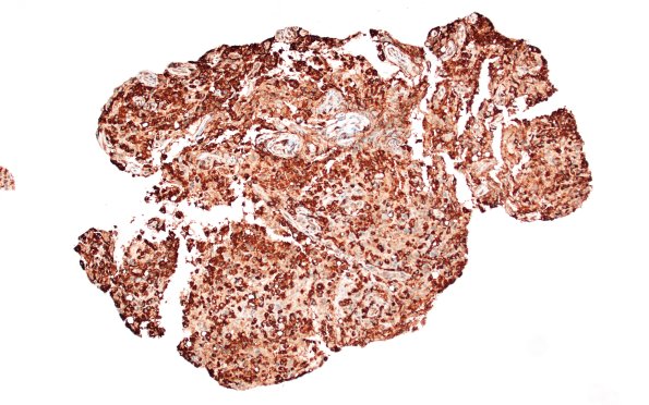 17G1 Demyelination, inflammatory (Case 17) CD68 10X 1