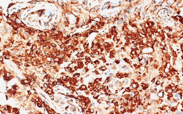 17G2 Demyelination, inflammatory (Case 17) CD68 40X 1