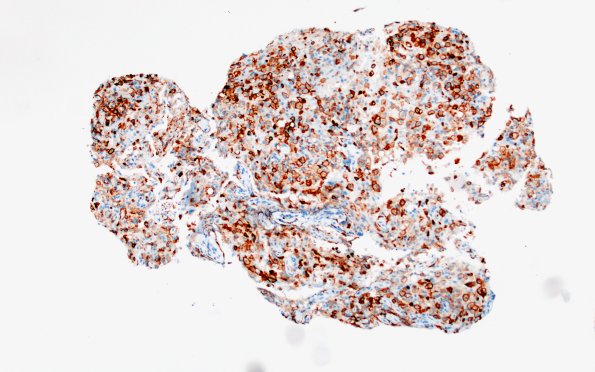 17H1 Demyelination, inflammatory (Case 17) CD163 10X 1