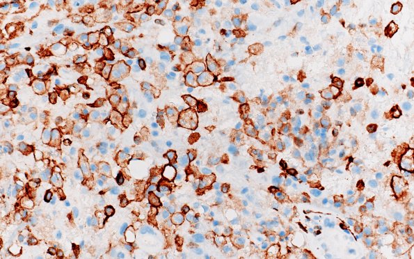 17H2 Demyelination, inflammatory (Case 17) CD163 40X 2