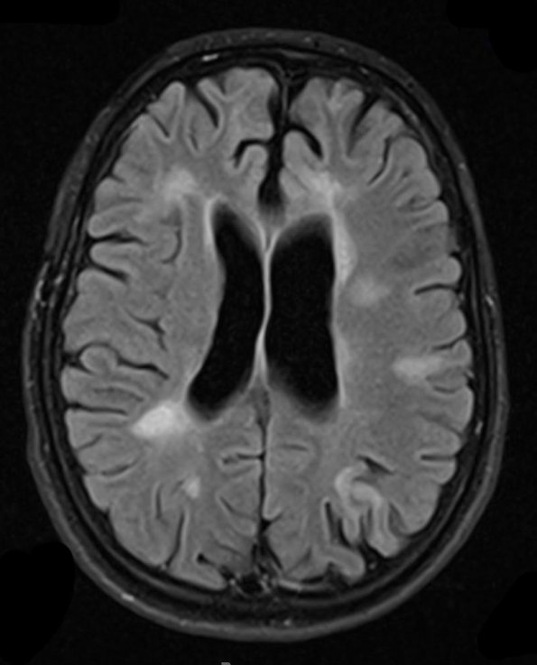 1B1 ADEM (Case 1) 1 year later T2 FLAIR - Copy
