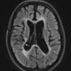 1C MS, Case 1, 7 years later1-6-2015, TIRM with Contrast copy - Copy