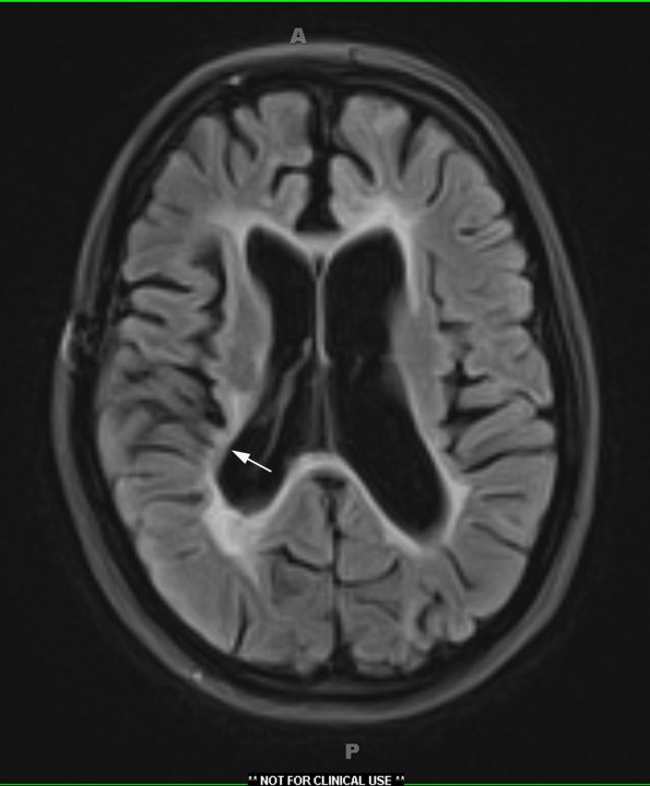 1C MS, Case 1, 7 years later1-6-2015, TIRM with Contrast copy - Copy