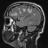 2A1 Inflammatory Demyelination (Case 2) 12 day earlier FLAIR 24 - Copy