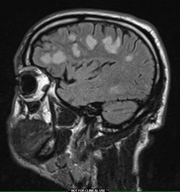 2A1 Inflammatory Demyelination (Case 2) 12 day earlier FLAIR 24 - Copy