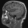 2A2 Inflammatory Demyelination (Case 2) 12 day earlier than Bx T1 without contrast 18 - Copy