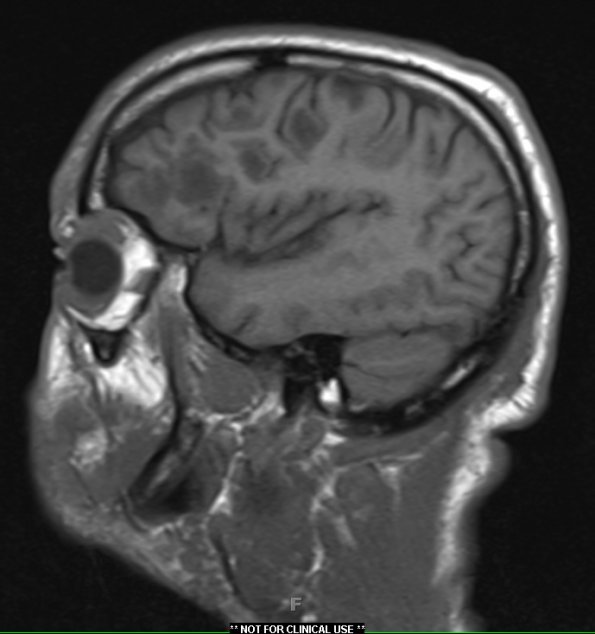 2A2 Inflammatory Demyelination (Case 2) 12 day earlier than Bx T1 without contrast 18 - Copy