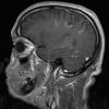 2A3 Inflammatory Demyelination (Case 2) 12 day earlier T1 with contrast 17 - Copy