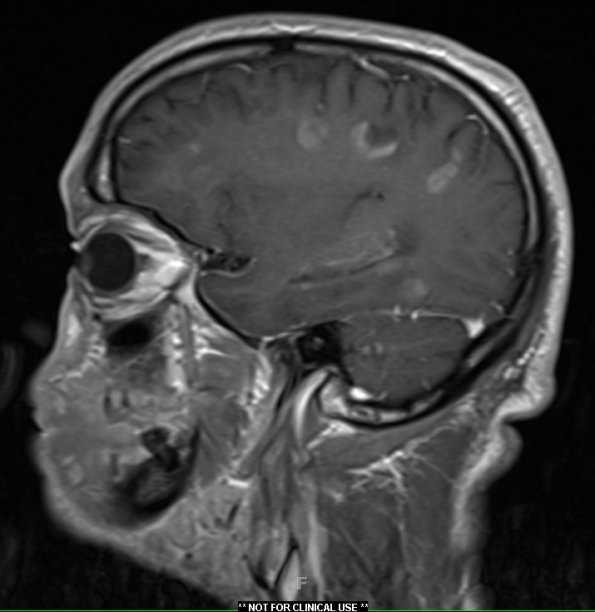 2A3 Inflammatory Demyelination (Case 2) 12 day earlier T1 with contrast 17 - Copy