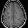 2A4 Inflammatory Demyelination (Case 2) 12 day earlier T1 without contrast 17 - Copy