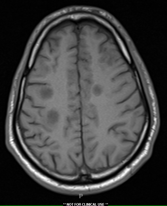 2A4 Inflammatory Demyelination (Case 2) 12 day earlier T1 without contrast 17 - Copy