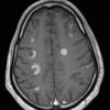 2A5 Inflammatory Demyelination (Case 2) 12 day earlier T1 With contrast  17 - Copy