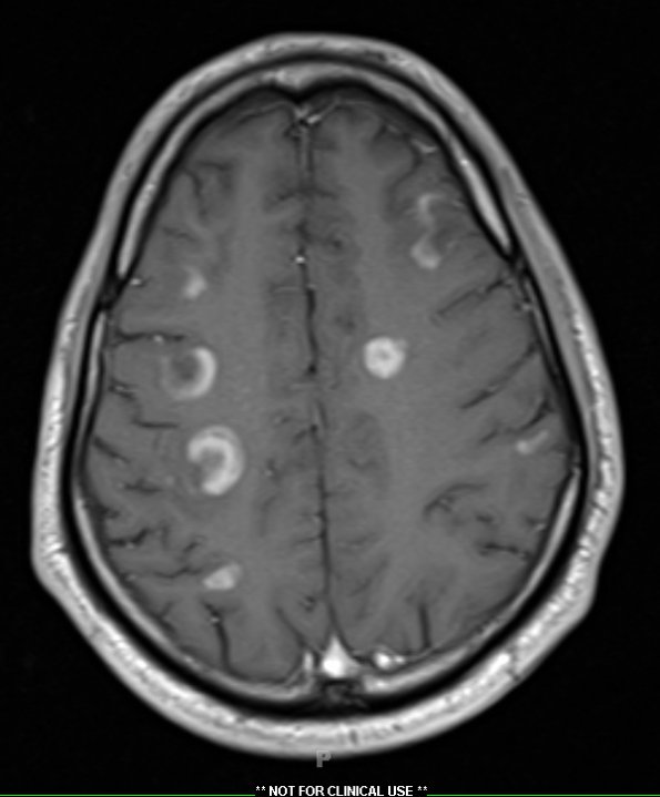 2A5 Inflammatory Demyelination (Case 2) 12 day earlier T1 With contrast  17 - Copy