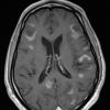 2A6 Inflammatory Demyelination (Case 2) 12 day earlier T1 with contrast 14 - Copy