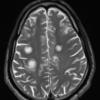 2A7 Inflammatory Demyelination (Case 2) 12 day earlier T2  17 - Copy