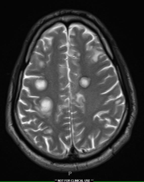 2A7 Inflammatory Demyelination (Case 2) 12 day earlier T2  17 - Copy