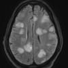 2B1 Inflammatory Demyelination (Case 2) time of Bx FLAIR 18 - Copy