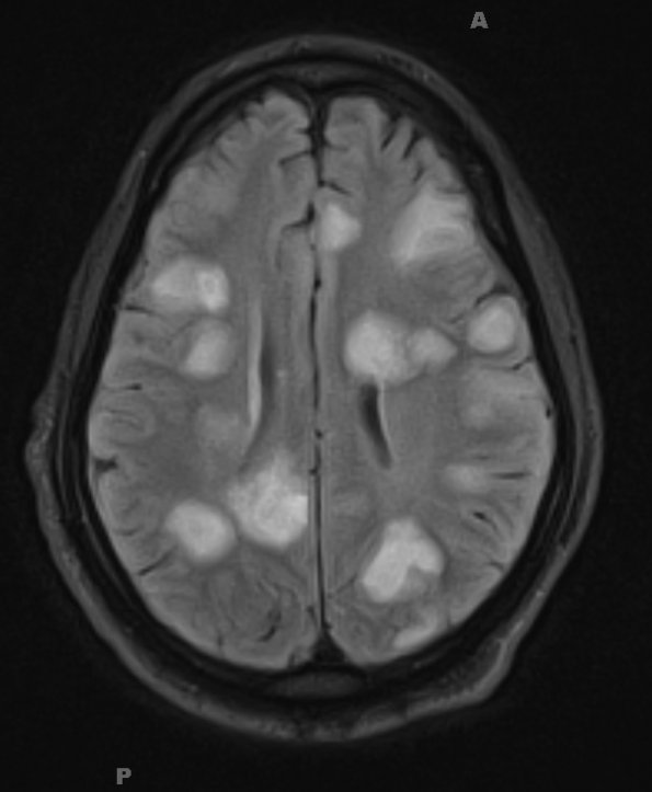 2B1 Inflammatory Demyelination (Case 2) time of Bx FLAIR 18 - Copy