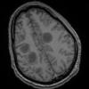 2B2 Inflammatory Demyelination (Case 2) Time of Bx T1 131 - Copy