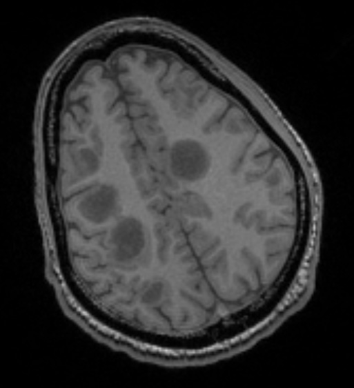 2B2 Inflammatory Demyelination (Case 2) Time of Bx T1 131 - Copy