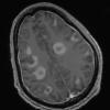 2B3 Inflammatory Demyelination (Case 2) Time of Bx T1W 129 - Copy