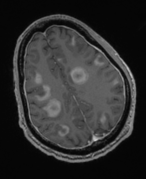 2B3 Inflammatory Demyelination (Case 2) Time of Bx T1W 129 - Copy