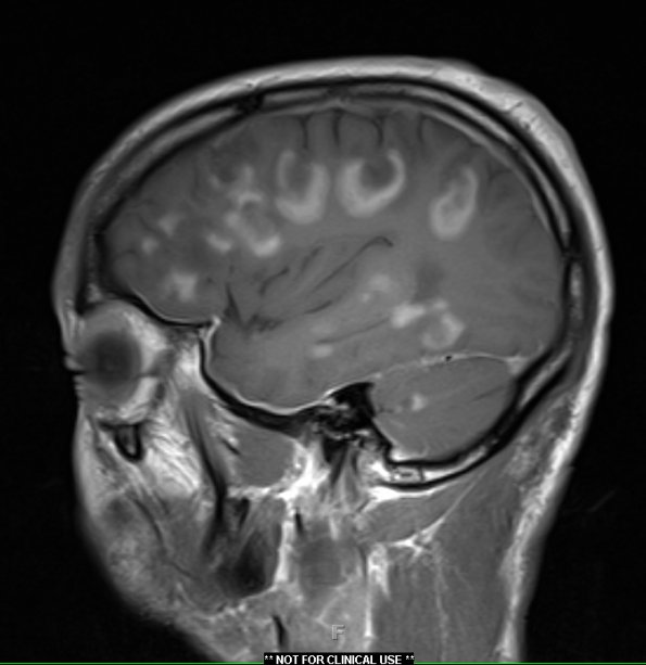 2B4 Inflammatory Demyelination (Case 2) Time of Bx T1W 9 - Copy