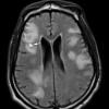 2C1 Inflammatory Demyelination (Case 2) 9 days of Rx FLAIR 15 copy