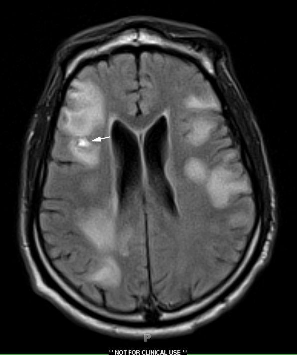 2C1 Inflammatory Demyelination (Case 2) 9 days of Rx FLAIR 15 copy