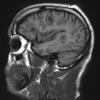 2C2 Inflammatory Demyelination (Case 2) 9 days of Rx T1 no contrast 7 - Copy