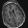 2C3 Inflammatory Demyelination (Case 2) 9 days of Rx T1W 15 (120) - Copy