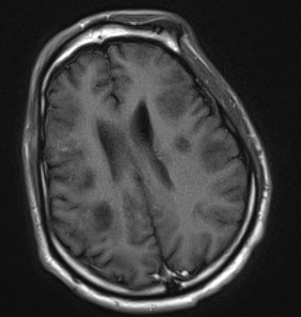 2C3 Inflammatory Demyelination (Case 2) 9 days of Rx T1W 15 (120) - Copy