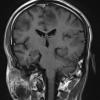 2C4 Inflammatory Demyelination (Case 2) 9 days of Rx T1W 16 (14) - Copy