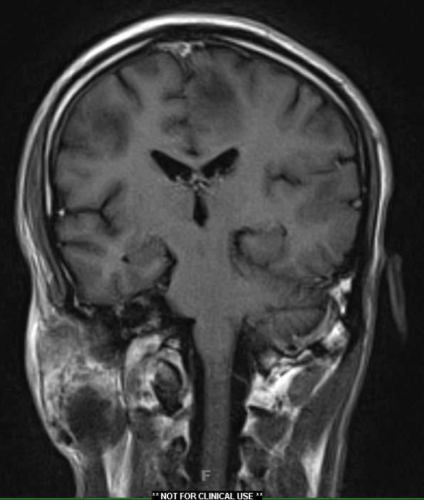 2C4 Inflammatory Demyelination (Case 2) 9 days of Rx T1W 16 (14) - Copy