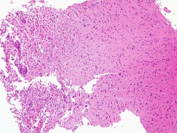 2D2 Inflammatory Demyelination (Case 2) Area A 10X H&E 2