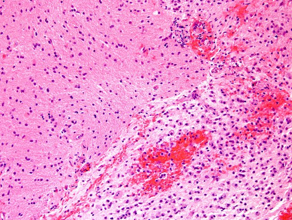 2D3 Inflammatory Demyelination (Case 2) Area A 20X H&E