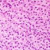 2D4 ADEM-MS-Inflammatory Demyelination (Case 2) H&E 40X