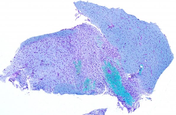 2E1 Inflammatory Demyelination (Case 2) Area A 4X LFB-PAS