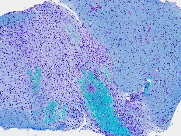 2E2 Inflammatory Demyelination (Case 2) Area A 10X LFB-PAS