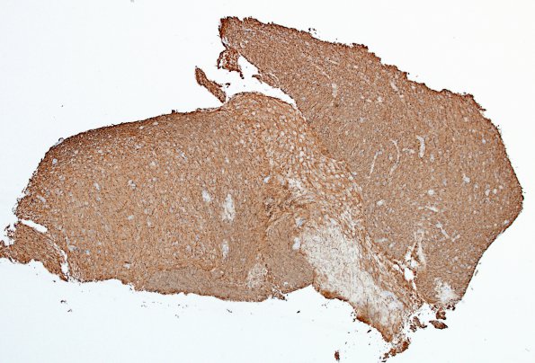 2F1 Inflammatory Demyelination (Case 2) Area A 4X NF