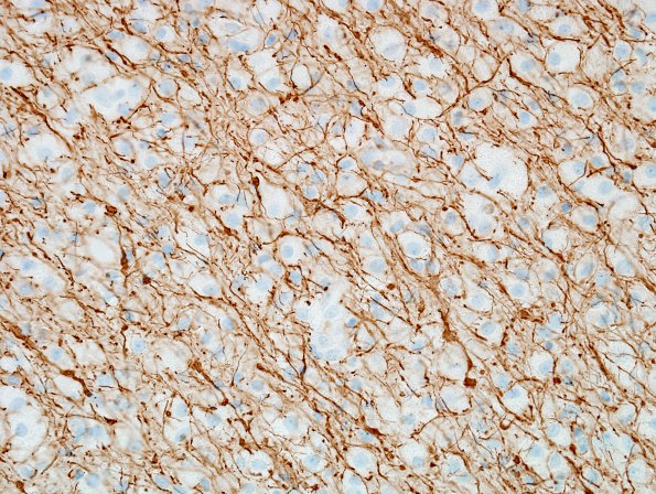 2F3 Inflammatory Demyelination (Case 2) Area B 40X NF