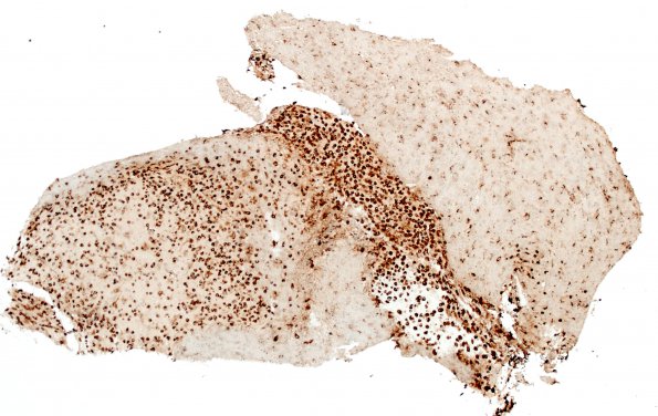 2G1 Inflammatory Demyelination (Case 2) Area A 4X CD68