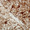 2I3 ADEM-MS-Inflammatory Demyelination (Case 2) GFAP 40X