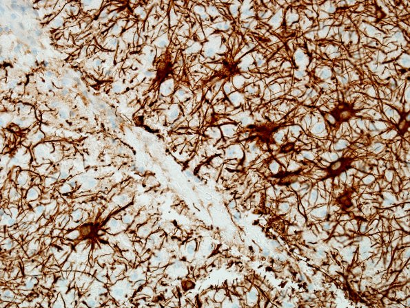 2I3 ADEM-MS-Inflammatory Demyelination (Case 2) GFAP 40X