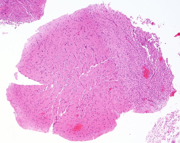 2J Inflammatory Demyelination (Case 2) Area C GM edge 4X H&E