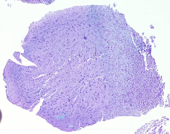 2K Inflammatory Demyelination (Case 2) Area C GM edge 4X LFB-PA