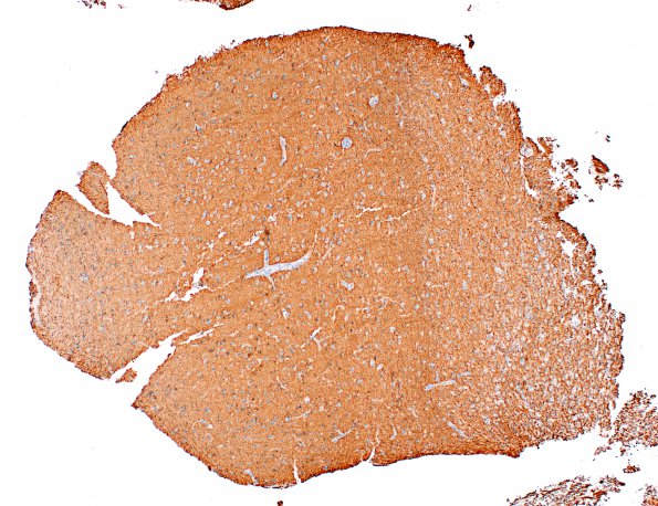 2L1 Inflammatory Demyelination (Case 2) Area C GM edge 4X NF 1